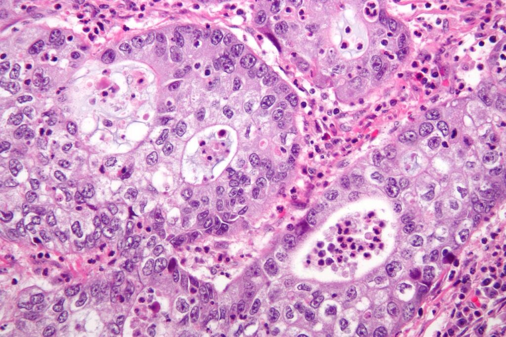 Metastasi Tumorali: Nuovo metodo terapeutico